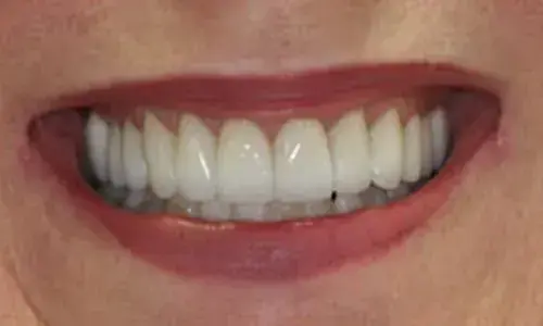A completed case at Artistry Smile Center