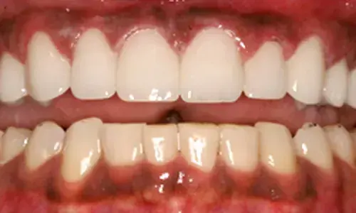 The same teeth after professional whitening