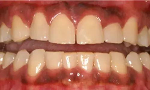 Stained teeth before professional whitening