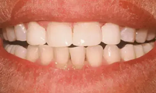 A completed case at Artistry Smile Center