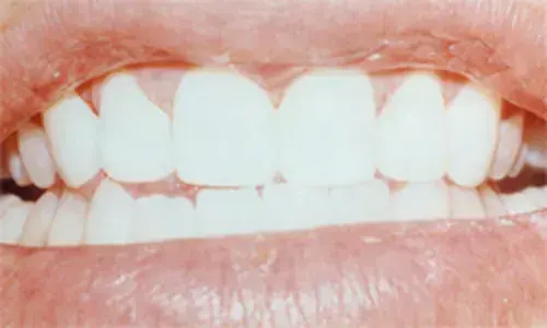 The same front teeth after porcelain veneers