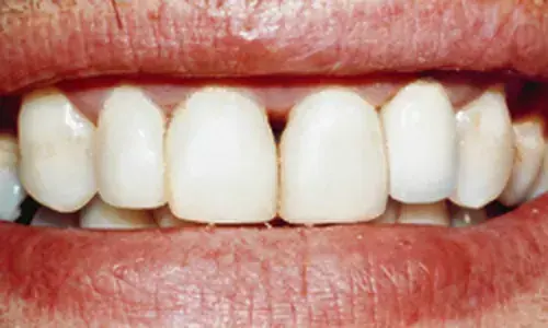 The same smile after full restoration
