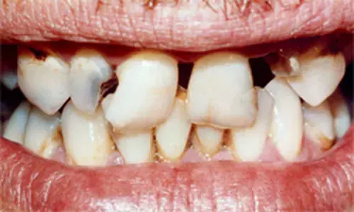 A broken and decayed smile before full restoration