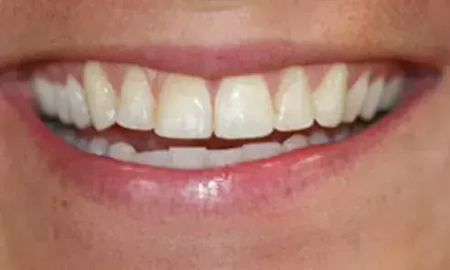 A patient&rsquo;s smile before treatment at Artistry Smile Center