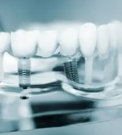 A dental implant model shown at a consultation